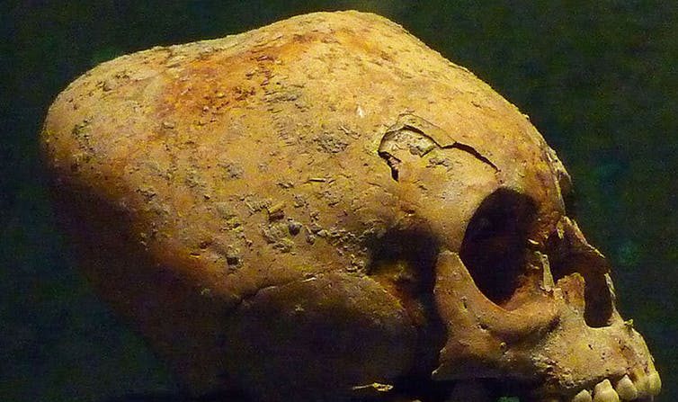 Crâne maya déformé. (Museo Nacional de Antropología e Historia, Mexico., Author provided)