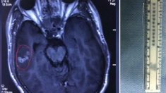Après des crises d’épilepsie, les médecins découvrent un ver solitaire dans son cerveau