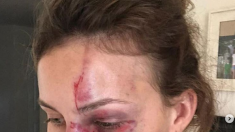 Frappée et violentée par son compagnon, elle poste les clichés de son visage tuméfié sur Instagram