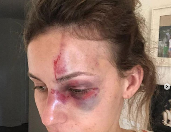 Melissa Gentz dénonce les violences de son compagnon en postant des photos de son visage sur Instagram. (Capture d’écran Instagram/melissalgentz)