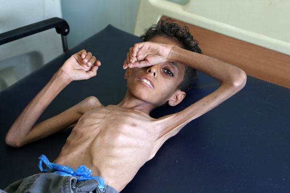 Yemeni boy Ghazi Ali bin Ali à 10 ans, il souffre de malnutrition sévère.      (Photo :  AHMAD AL-BASHA/AFP/Getty Images)