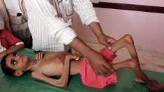 Au Yémen, un hôpital se débat pour sauver des enfants malnutris