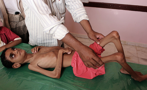 -Un enfant yéménite souffrant de malnutrition reçoit des soins dans un centre de traitement d'un hôpital de la province hajjah du nord-ouest du Yémen, le 25 octobre 2018. Photo ESSA AHMED / AFP / Getty Images.