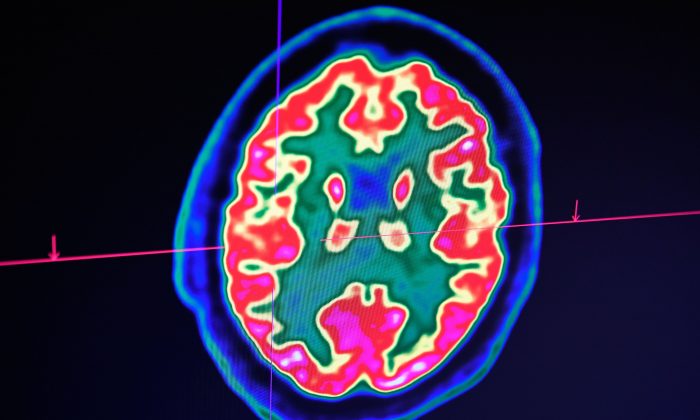 Sur cette image, un cerveau humain est pris par un scanner de tomographie par émission de positons, également appelé TEP, au Centre Hospitalier Régional et Universitaire de Brest, dans l'ouest de la France le 9 janvier 2019. (Fred TANNEAU / AFP/Getty Images)