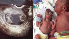 Une maman refuse le conseil d’un médecin d’interrompre la grossesse de l’un de ses jumeaux – 34 semaines plus tard, c’est la meilleure des décisions