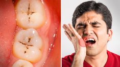 6 clés pour éviter la carie dentaire – les dentistes révèlent que ce n’est pas aussi simple que de se brosser les dents