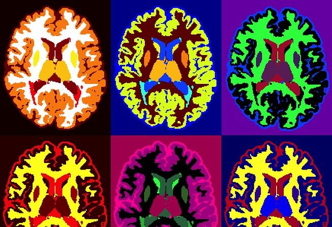 Images du cerveau d'une personne atteinte de sclérose en plaques, obtenues par IRM.
Ilena George et Daniel Reich, Institut national des troubles neurologiques et des accidents vasculaires cérébraux, Instituts nationaux de la santé.