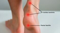 Tendinite du tendon d’Achille : symptômes, causes et traitement
