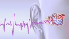 La stimulation électrique du canal auditif est prometteuse en tant que traitement potentiel des acouphènes