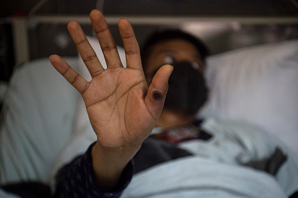 Un patient montre sa main avec une plaie causée par une infection par le virus de la variole du singe, à l'hôpital Arzobispo Loayza, à Lima, au Pérou. (ERNESTO BENAVIDES/AFP via Getty Images)