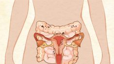 Endométriose : symptômes, causes, traitements et approches naturelles