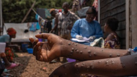 Mpox : l’OMS donne son feu vert au premier test de dépistage